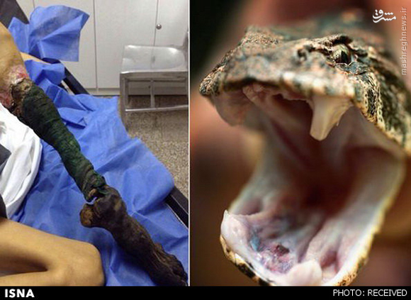 مارگزیدگی عجیب در ونزوئلا +عکس