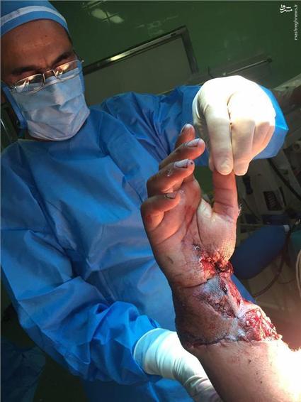 پیوند دست قطع شده در رشت +16/عکس