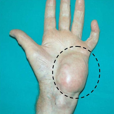 ØªØ¨ Ùˆ Ø³Ø§Ø±Ú©ÙˆÙ…, Ø¹Ù„Ø§ÛŒÙ… Ø³Ø±Ø·Ø§Ù† Ø³Ø§Ø±Ú©ÙˆÙ…