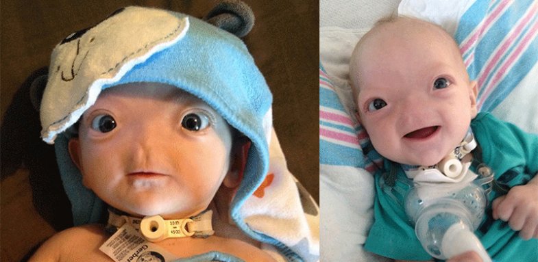 پسری که بدون بینی متولد شد