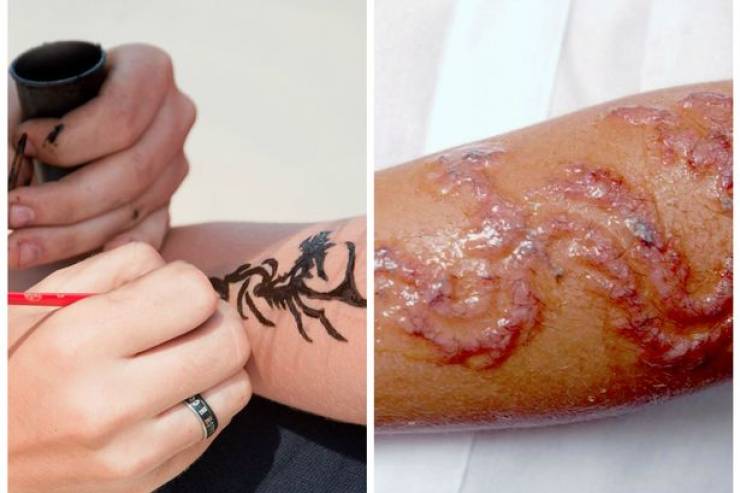 عاقبت وحشتناک خالکوبی با حنا سیاه روی دست دختر 7 ساله+عکس