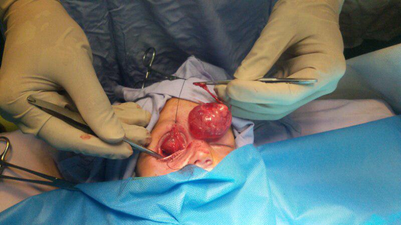 کودکی که باچشم از حدقه بیرون زده متولد شد فردا مرخص می شود + تصاویر